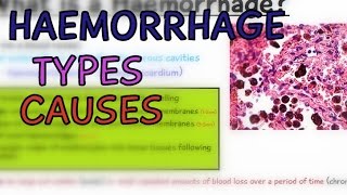 Pathology Lectures Haemorrhage Types and Causes Hemorrhage  EXPLAINED IN 4 MINUTES [upl. by Aliuqahs]