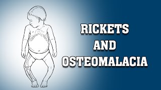 Osteomalacia amp Osteoporosis I Clinical approach I Pathophysiology inicet2023 mcq neetpg [upl. by Sophy]