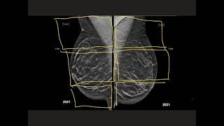 How to read a screening mammogram [upl. by Bluefield]