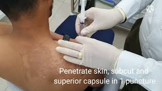 SHOULDER AC JOINT STEROID INJECTION TECHNIQUE DR PRADEEP BALA [upl. by Yelkrab]