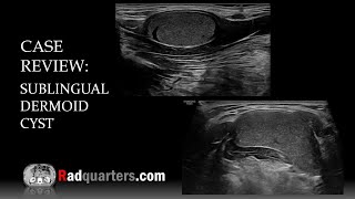 Ultrasound of Sublingual Dermoid Cyst [upl. by Dihsar]