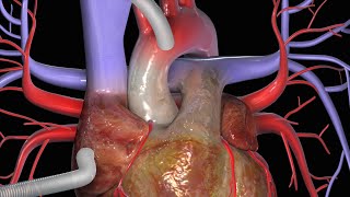 Coronaire bypass CABG [upl. by Haerr893]