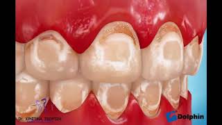 Decalcification Orthodontics  Dr Tzortzi [upl. by Alimat]