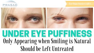 Puffiness Under Eyes that Only Appears When Smiling Does Not Need Cosmetic Treatment [upl. by Ailet]