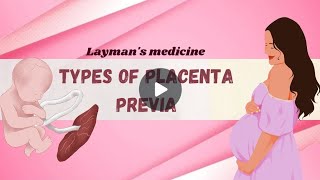 Types of Placenta Previa  English animation [upl. by Enoed]