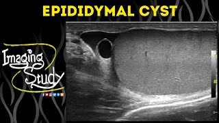 Epididymal Cyst  Ultrasound  Case 51 [upl. by Enelrahc470]