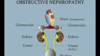 Posterior Urethral Valves  Obstructive Nephropathy [upl. by Giah]