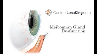 Meibomian Gland Dysfunction  Dry Eye Treatment [upl. by Nickolaus196]