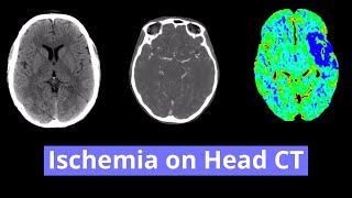 Ischemia on Head CT [upl. by Algy]