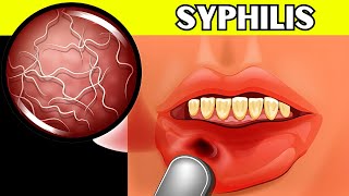 Syphilis  Causes Signs amp Symptoms Pathogenesis Diagnosis And Treatment [upl. by Lanta]