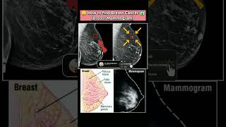 🤔How to find Breast Cancer😱 cancer breastcancer xray youtubeshorts mammogram disease medical [upl. by Argus524]