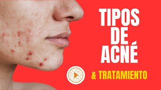 ¿QUÉ TIPO DE ACNE TIENES La identificación y el tratamiento habitual de los tipos de acné [upl. by Gaidano]