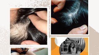 homoeopathy alopecia areatablaldnesshairfallphosphursarnicajaborandiacid phosgraphites [upl. by Elvis]