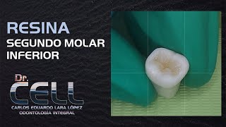 Resina Dental Paso a Paso  Segundo Molar Inferior  Dr CELL [upl. by Portuna]