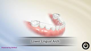 Lower Lingual Arch to Preserve Leeway Space  Dental Braces  Temecula Valley CA [upl. by Narbig]