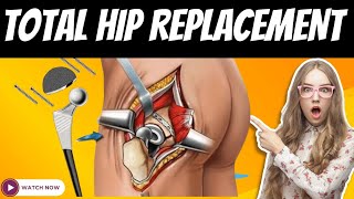 TOTAL HIP REPLACEMENT  EXPLANATION VIDEO  Medical students medicalstudent physiotherapy physio [upl. by Pavel]