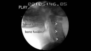 Zenkers diverticulum Barium Swallow [upl. by Akeret]