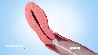 Sperm Retrieval Techniques [upl. by Hpeosj]