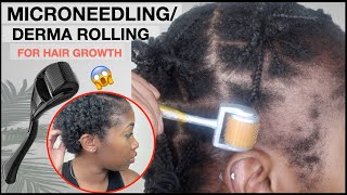 MICRONEEDLINGDERMA ROLLING FOR EDGE GROWTH  Two Month Update  TRACTION ALOPECIA 🚨 NO MINOXIDIL [upl. by Oidualc196]