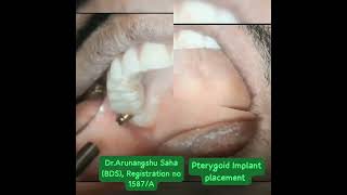 Pterygoid Implant [upl. by Nellie951]