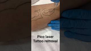 Picosecond laser tattoo removal TattooRemoval picolaser LaserTreatment beauty tattoo too [upl. by Carmon]