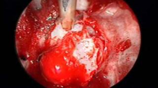 pituitary adenoma endoscopic endonasal Demo [upl. by Eppillihp]