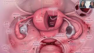 Endometriosis amp Fertility Webinar [upl. by Naihtsirc]