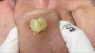 cystic acne blackhead whitehead removal  Relaxing Spa Acne Treatment [upl. by Fanni426]