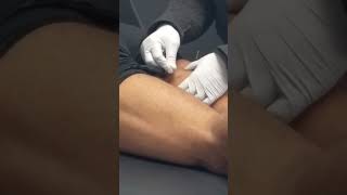 Dry Needling Hamstring [upl. by Deland]