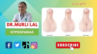 Hypospadias drmurlilal hypospadias exstrophy bladder پيشاب جو سوراخ پنھنجي جڳھ تي نه ھجڻ [upl. by Cranford]