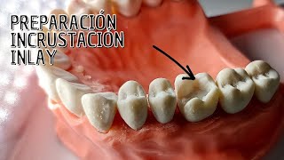 Preparación Incrustación dental Inlay [upl. by Yenohtna]