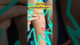 Normal Knee Vs Synovitis Knee🔥🔥घुटने में बड़ी सूजन का कारण kneeswellingeffusion kneejoint bone [upl. by Ffirahs]