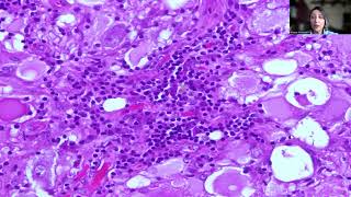 Tip39Ganglioglioma [upl. by Enitsyrhc]