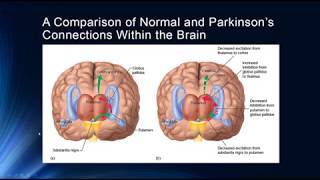 Movement Disorders [upl. by Anaya]