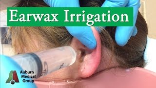 Ear Wax Irrigation  Auburn Medical Group [upl. by Narak]