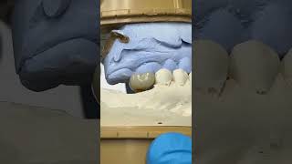 Zen Enamel Molar Implant teethwhitening dentist yellowteethwhitening shorts shortsvideo [upl. by Romalda629]