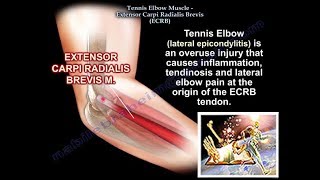 Tennis Elbow Extensor Carpi Radialis Brevis Everything You Need To Know  Dr Nabil Ebraheim [upl. by Ailak832]