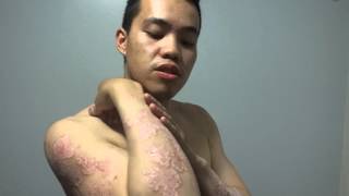 Psoriasis  Consentyx Journey day 1 Biological treatment [upl. by Backler]