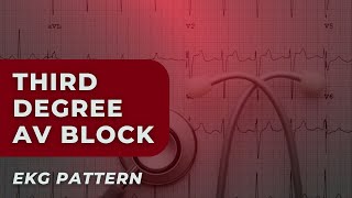 ThirdDegree Heart Block Understanding Your EKG ECG [upl. by Luz]