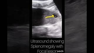 Ultrasound showing Spleen with focal lesion Ultrasound abdomen123ultrasonographyyoutubeshortsuk [upl. by Takeo]