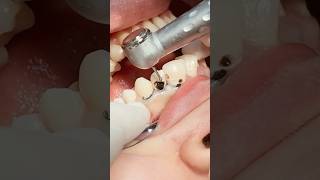 Deep caries fiber post and composite restoration dentist [upl. by Nottap]