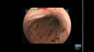 Hemorrhagic Gastropathy [upl. by Durman]