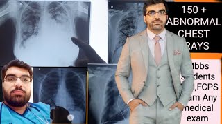 Chest XRays Explained How to Read and Interpret Chest XRayschestxraycxrxray [upl. by Dott]