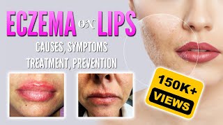 Eczema on lips causes symptoms treatment remedies prevention  Lip dermatitis Lip Cheilitis [upl. by Hannej989]