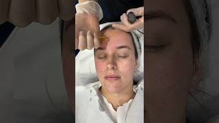 Microneedling with PRP  Dr Medispa [upl. by Lambrecht]