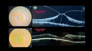 Surgery for VMT  CME  How to tackle Vitreo Macular Traction [upl. by Gudren166]