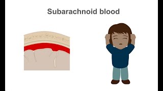 Discussing subarachnoid hemorrhage in trauma patients using CT angiography CTA [upl. by Hahseram]