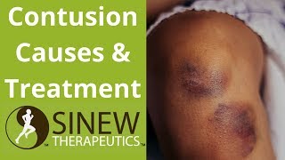 Contusion Causes and Treatment [upl. by Esya]