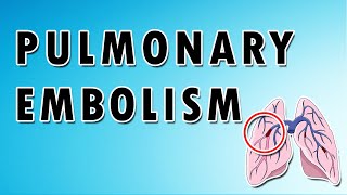 Pulmonary Embolism [upl. by Meador227]