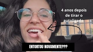 APARELHO AUTOLIGADO  4 ANOS DEPOIS O DENTE ENTORTOU [upl. by Thomasine676]